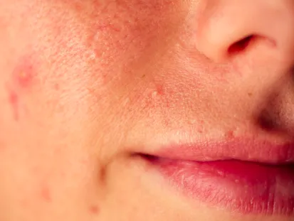 Rosacea